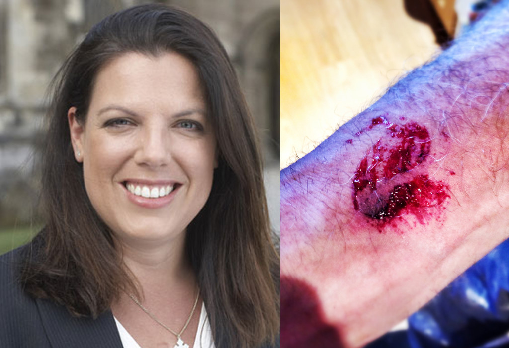 Caroline Nokes MP, attack on F4J Founder, assault and bite mark